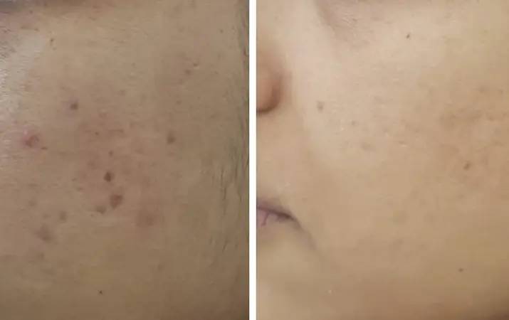 Microneedling Radiofrequency — before and after