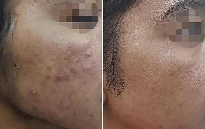Microneedling — before and after
