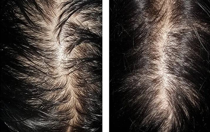 PRP — before and after