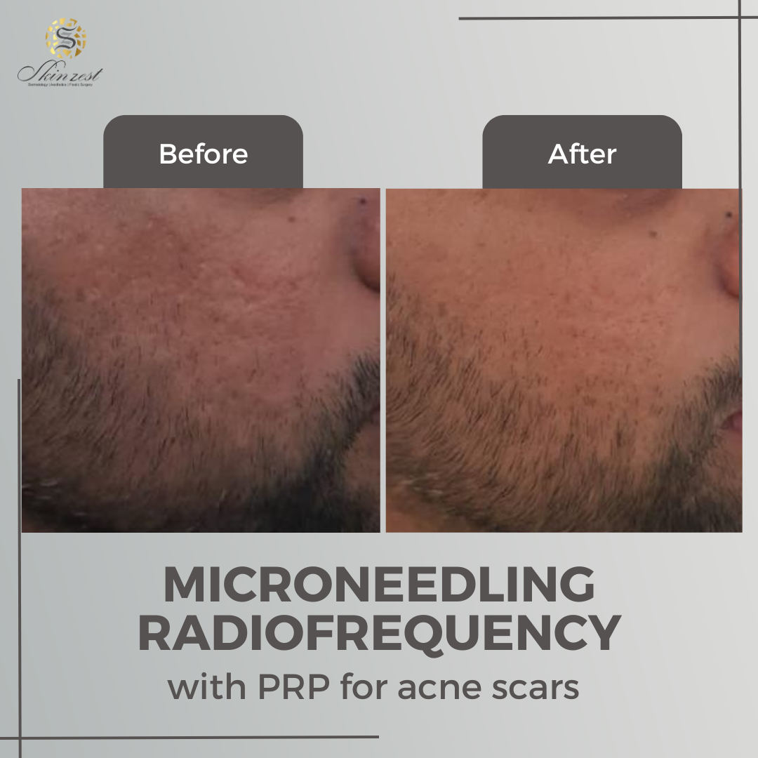 MNRF Treatment — before and after