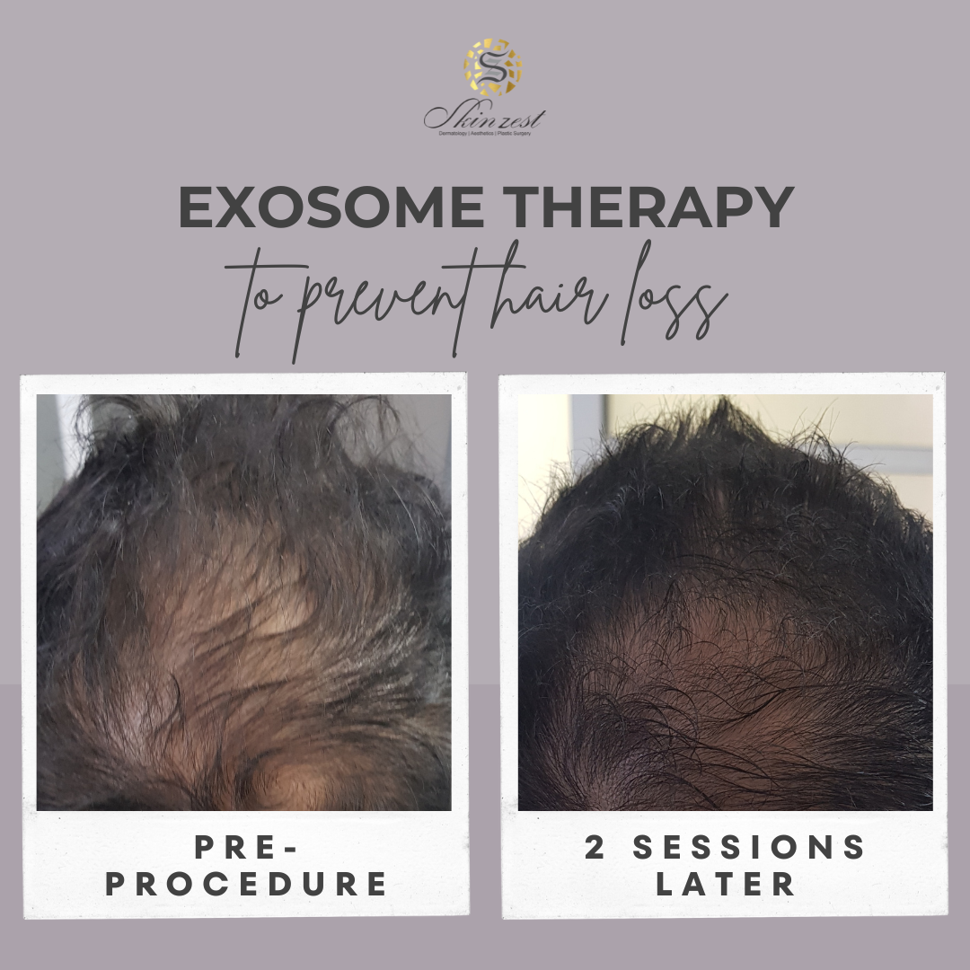 Exosome Therapy — before and after