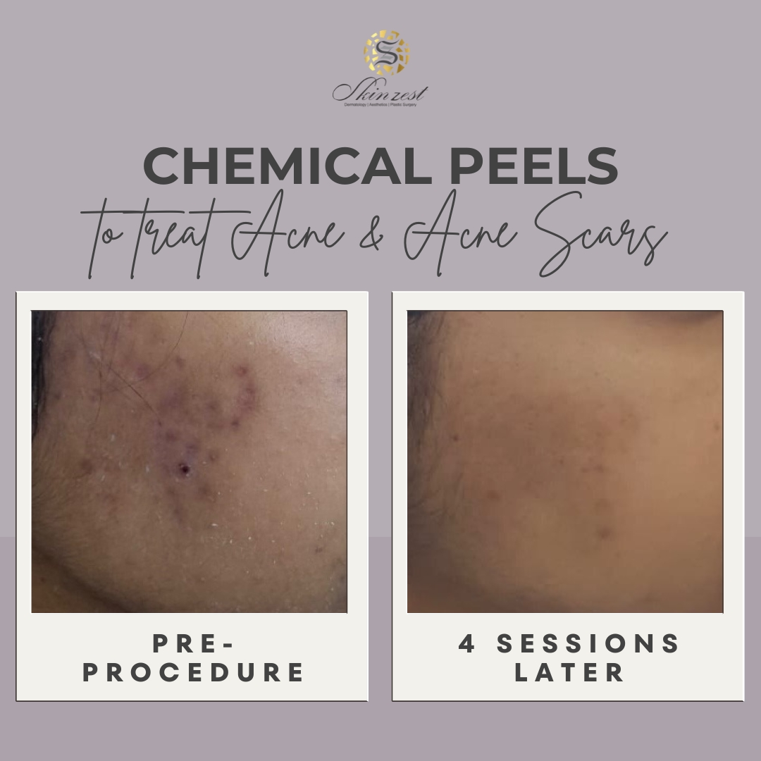 Chemical peel before and after: acne and acne scars after 4 sessions at Skinzest, Gurgaon