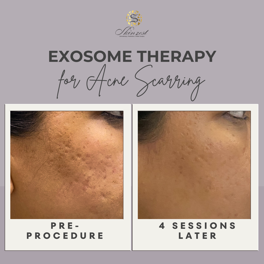 Exosome therapy for acne scarring: before and after 4 sessions at Skinzest, Gurgaon