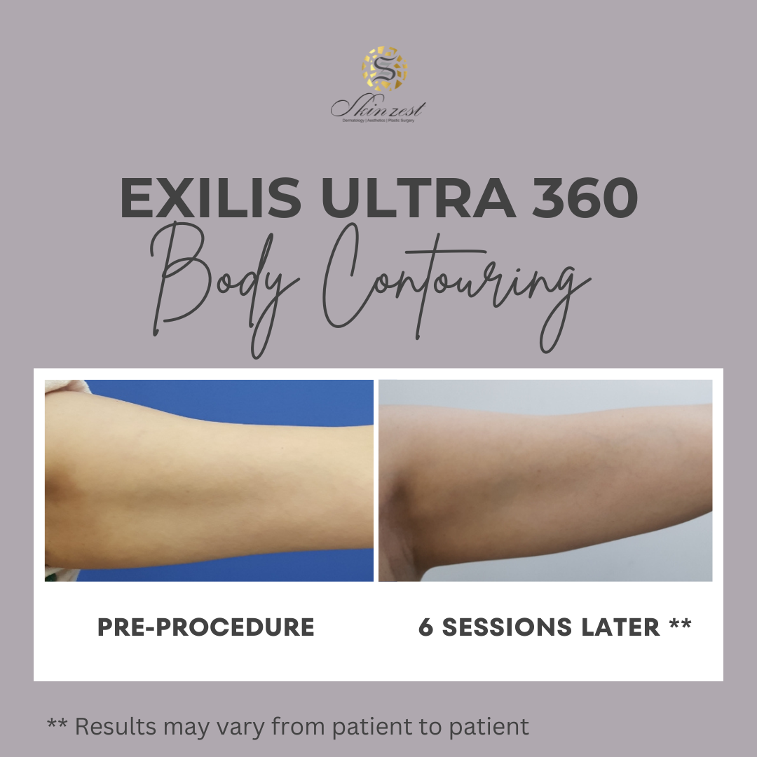 Exilis Treatment — before and after