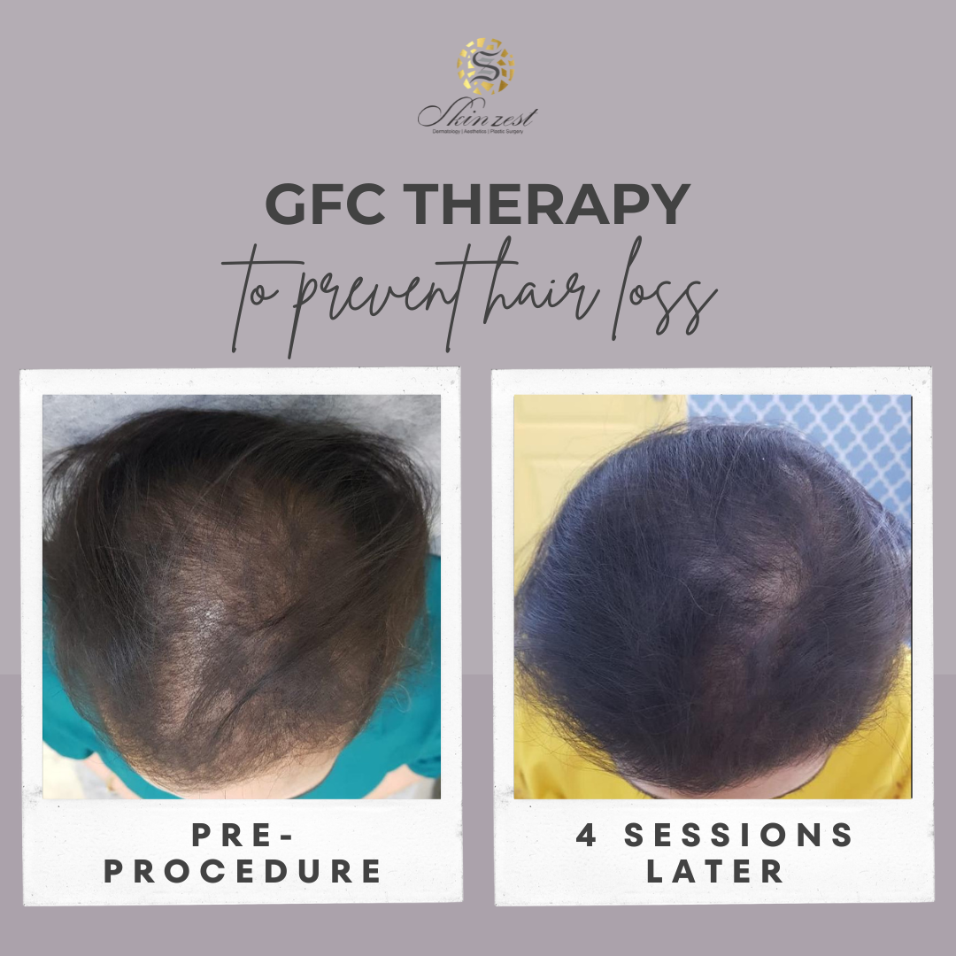 GFC Therapy — before and after