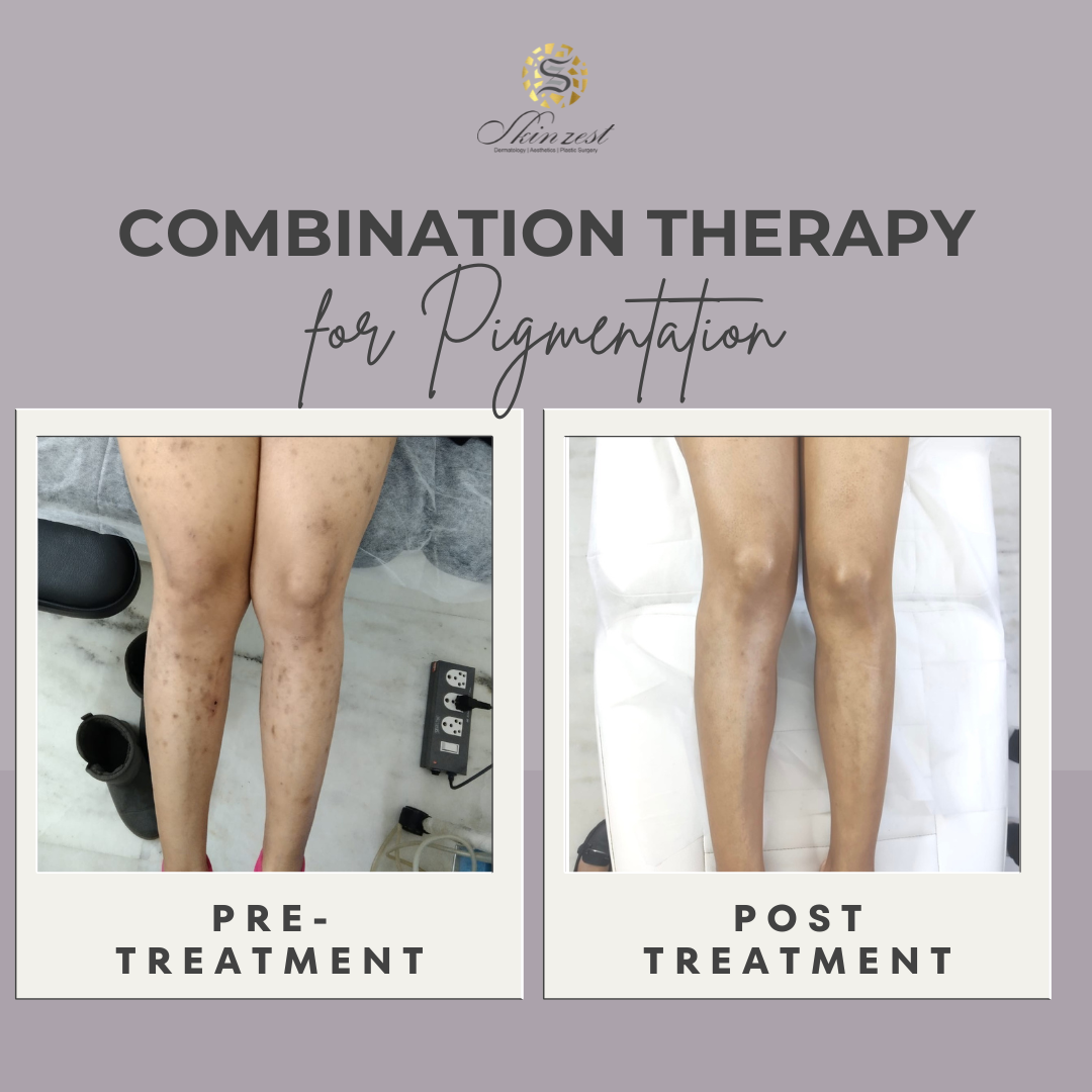 Pigmentation Treatment — before and after