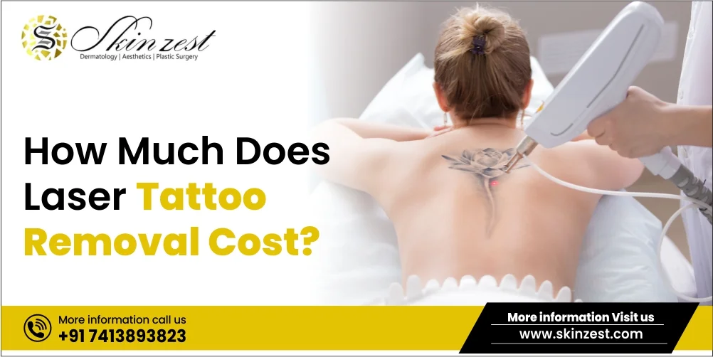 How Much Does Laser Tattoo Removal Cost?