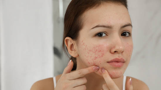 Beat the heat prevent acne and breakouts from sweaty skin with these skincare tips — Hindustan Times