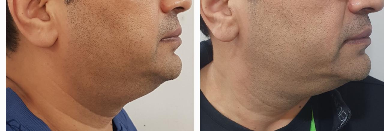 Jawline and neck — before and after