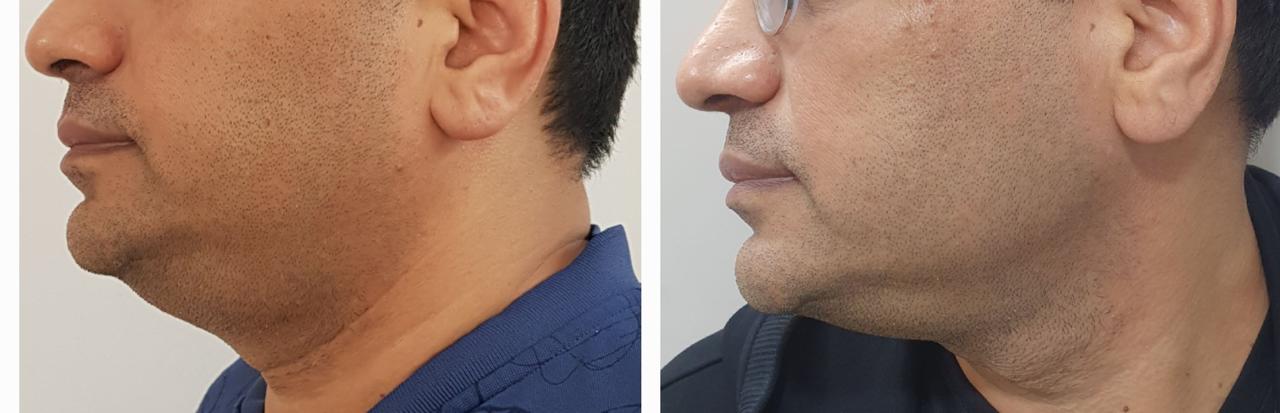 Jawline and neck — before and after