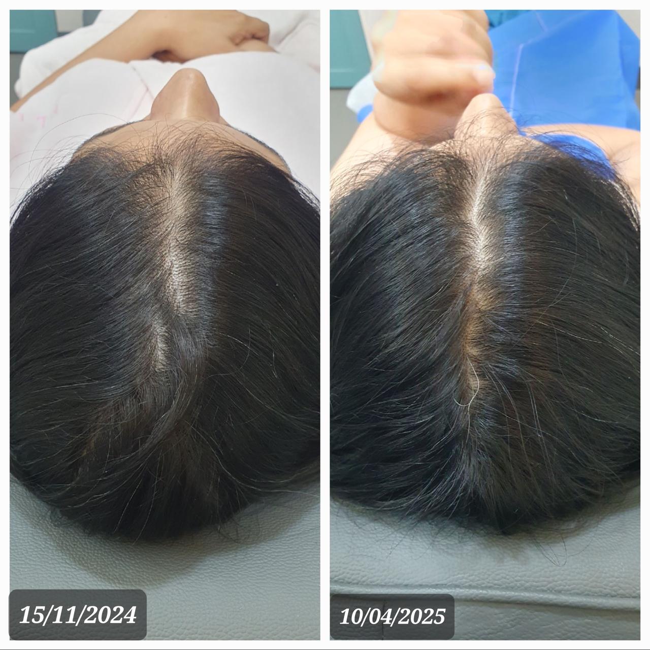 Hair density — before and after