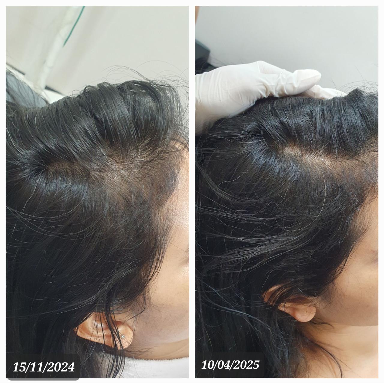 Hair density — before and after