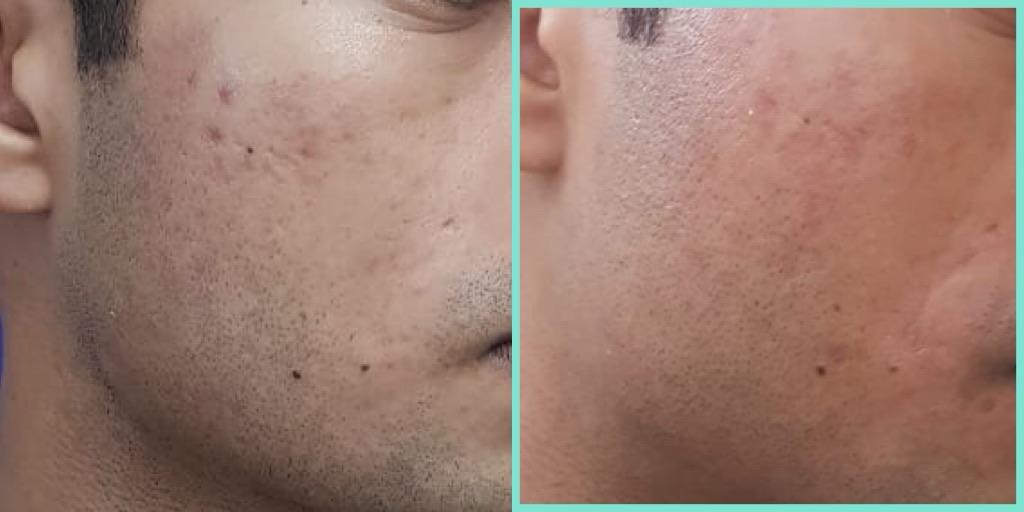 Skin texture — before and after