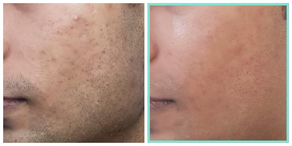 Skin texture — before and after