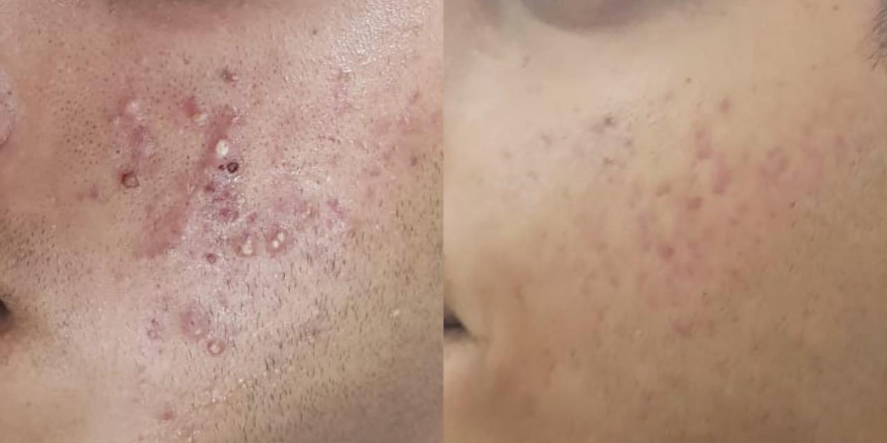 Acne Scar Treatment — before and after