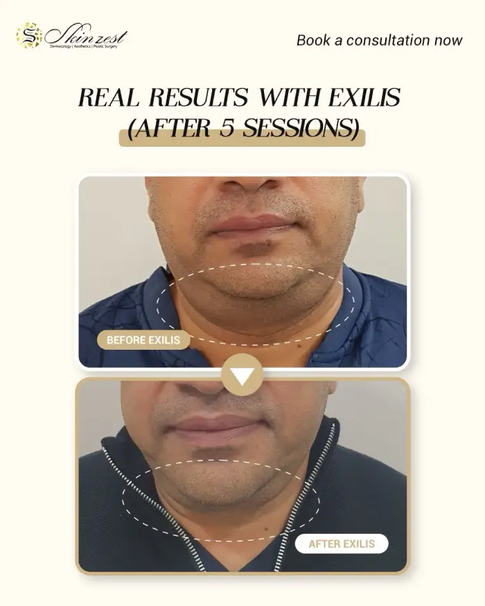 Exilis — after 5 sessions — before and after
