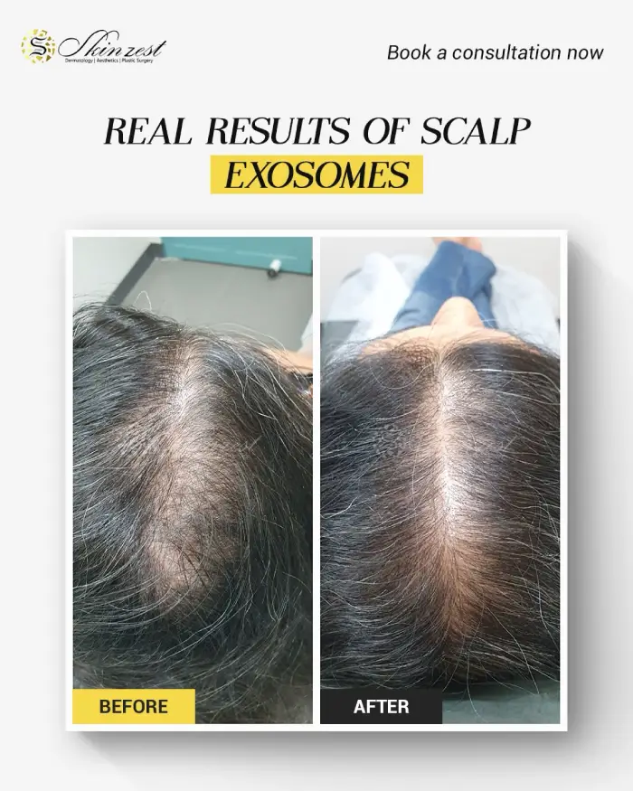 Scalp exosomes — before and after