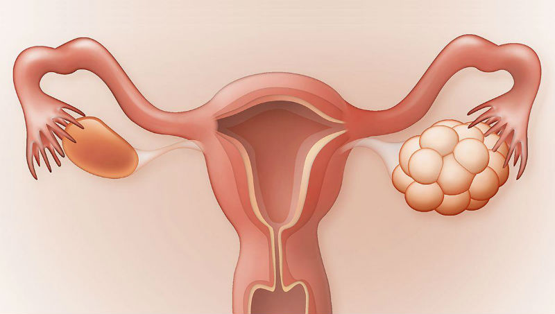 Polycystic Ovarian Syndrome (PCOS)