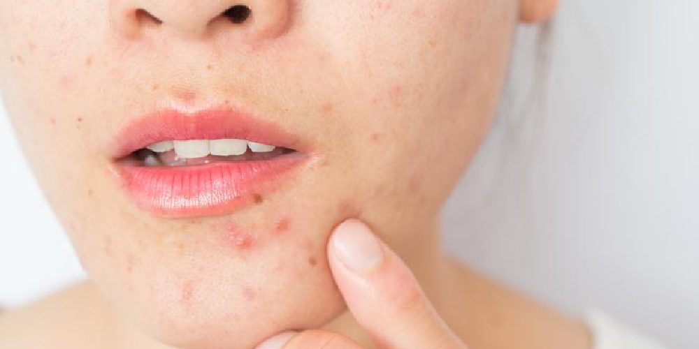 Get best acne treatment in Gurgaon at affordable cost by Dr Noopur Jain.Untreated acne/pimples/zits can leave long-term marks