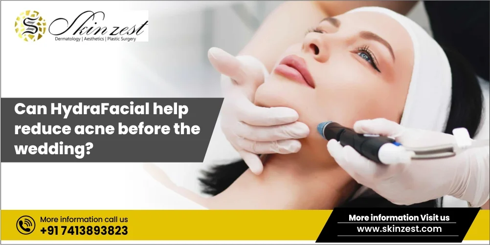 best HydraFacial in Gurgaon