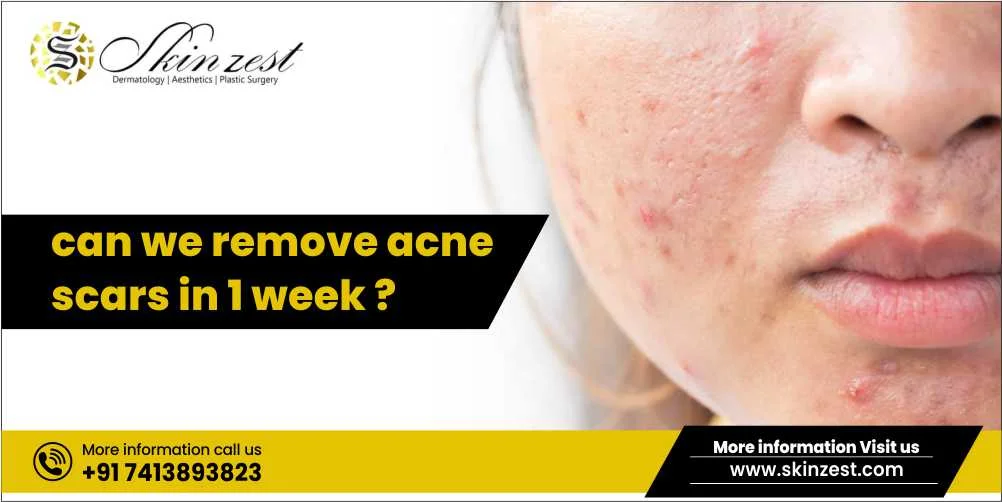 acne scar treatment in Gurgaon