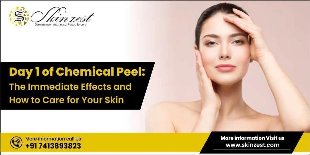 chemical peel treatment in Gurgaon
