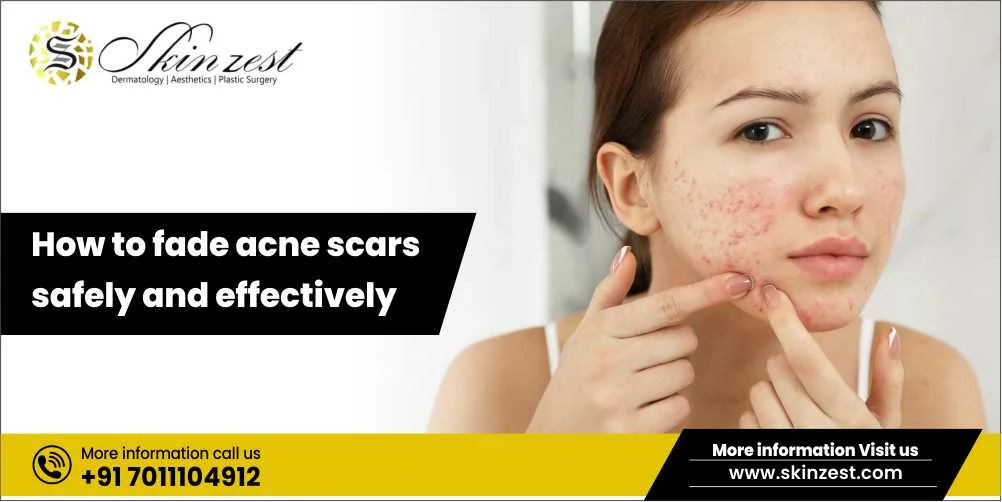 dermatologist-advice-for-acne-scar-treatment-showing-safe-procedures-like-laser-microneedling-and-peels-for-smoother-clearer-and-even-toned-skin